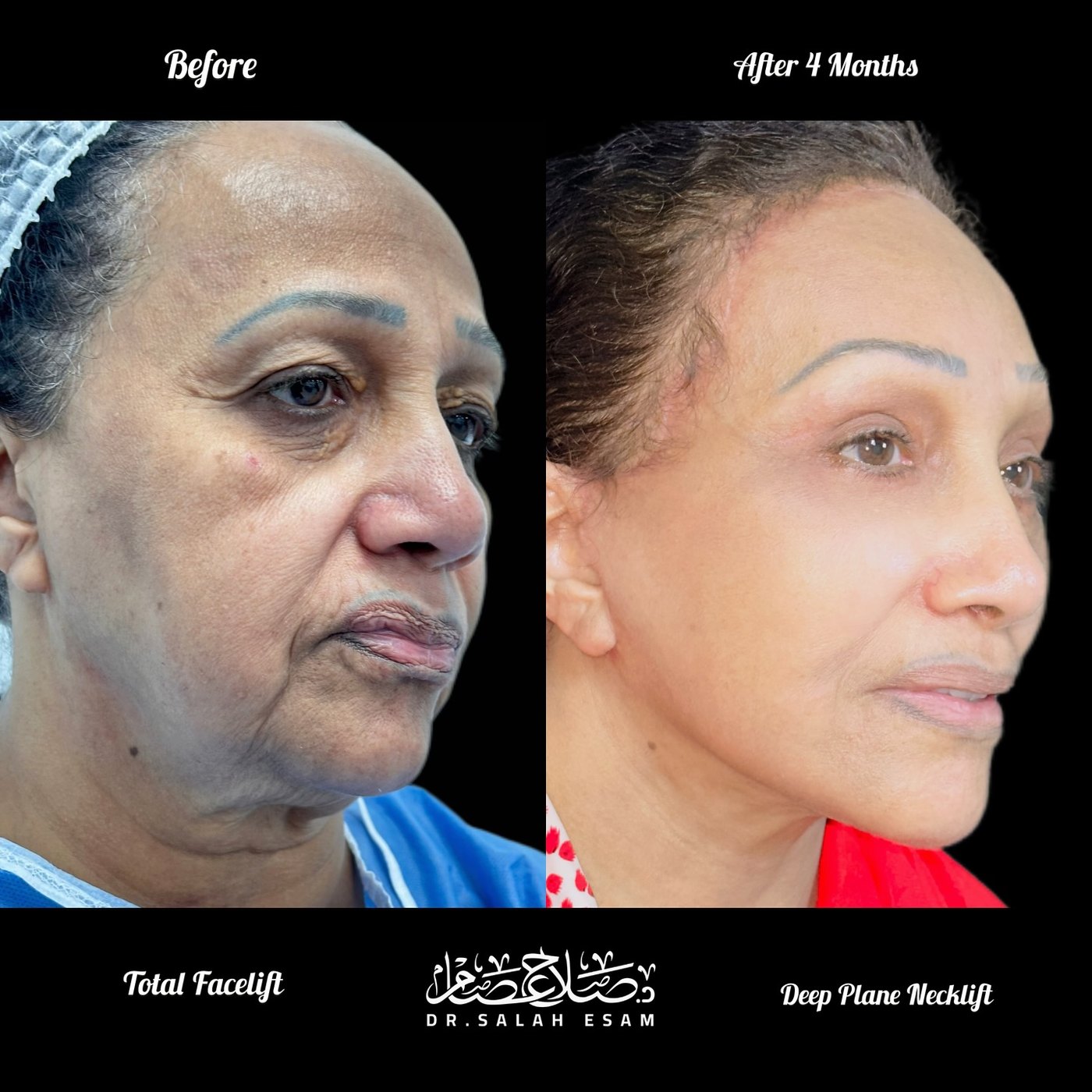 Total facelift and deep plane neck lift, before and after 4 months