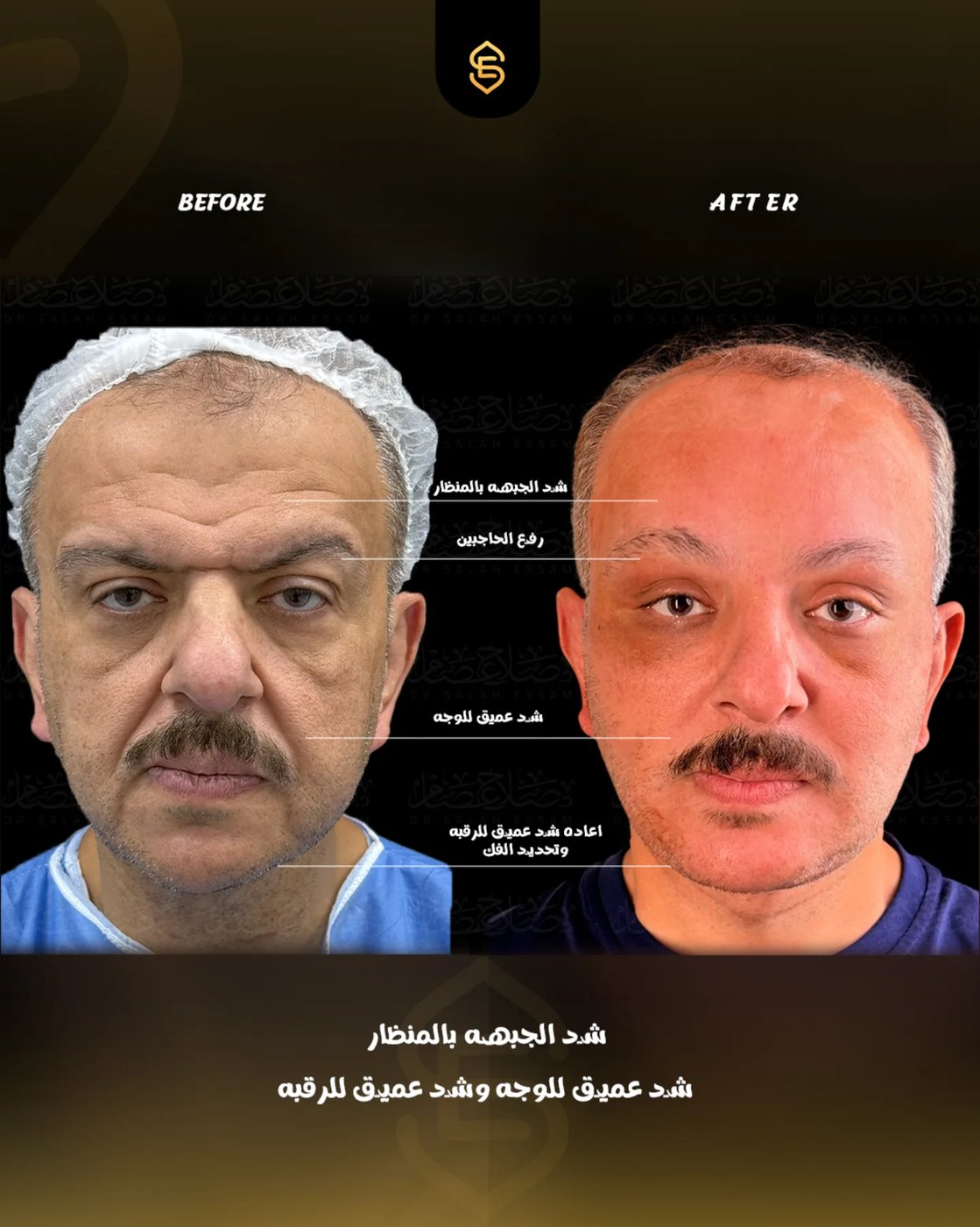 Endoscopic forehead lift, deep plane facelift and neck lift
