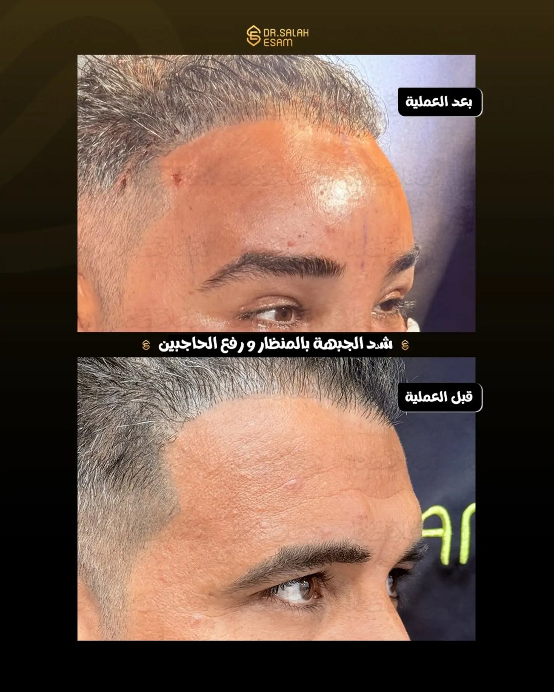 Endoscopic forehead lift and brow lift