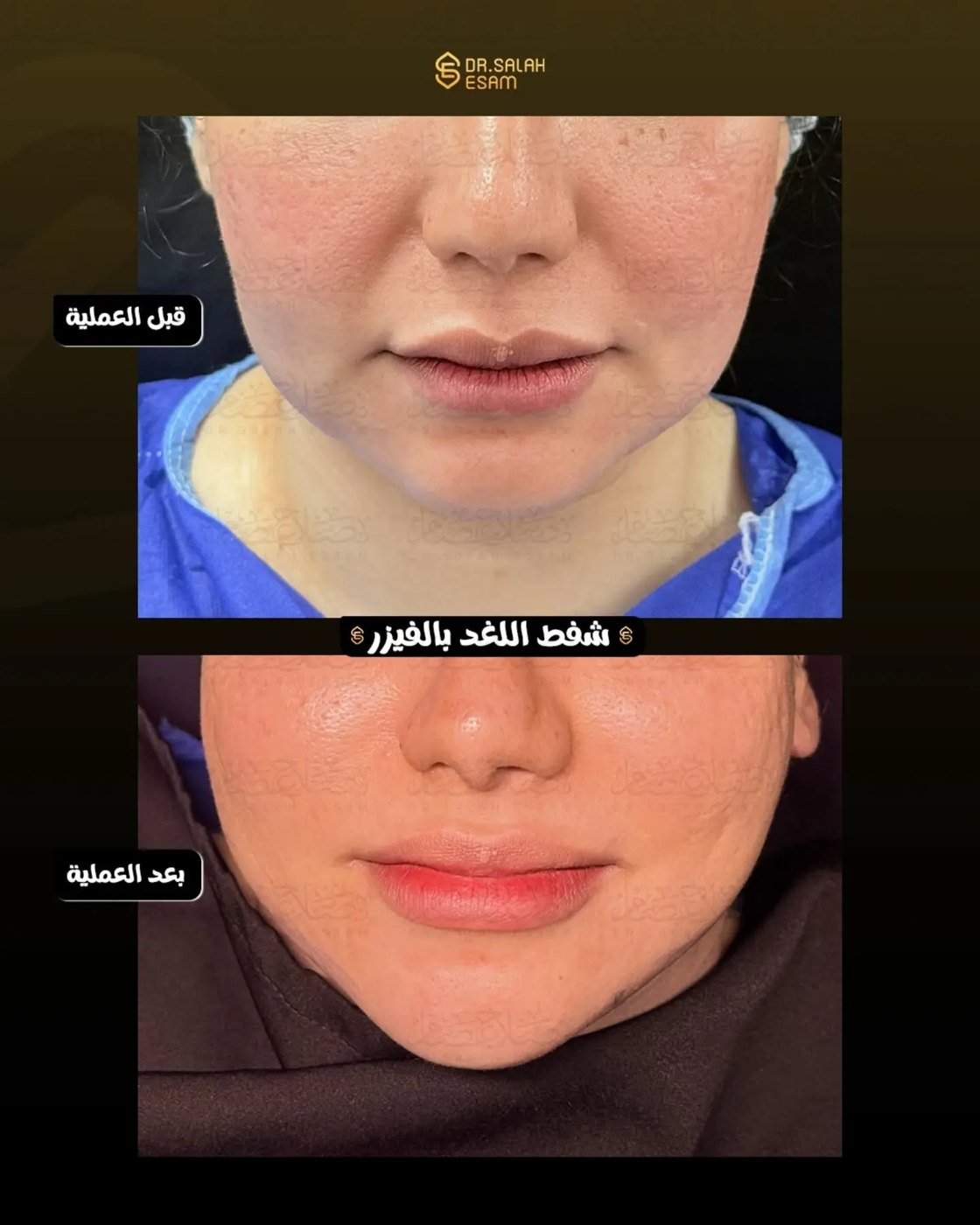 Jawline definition with Vaser liposuction