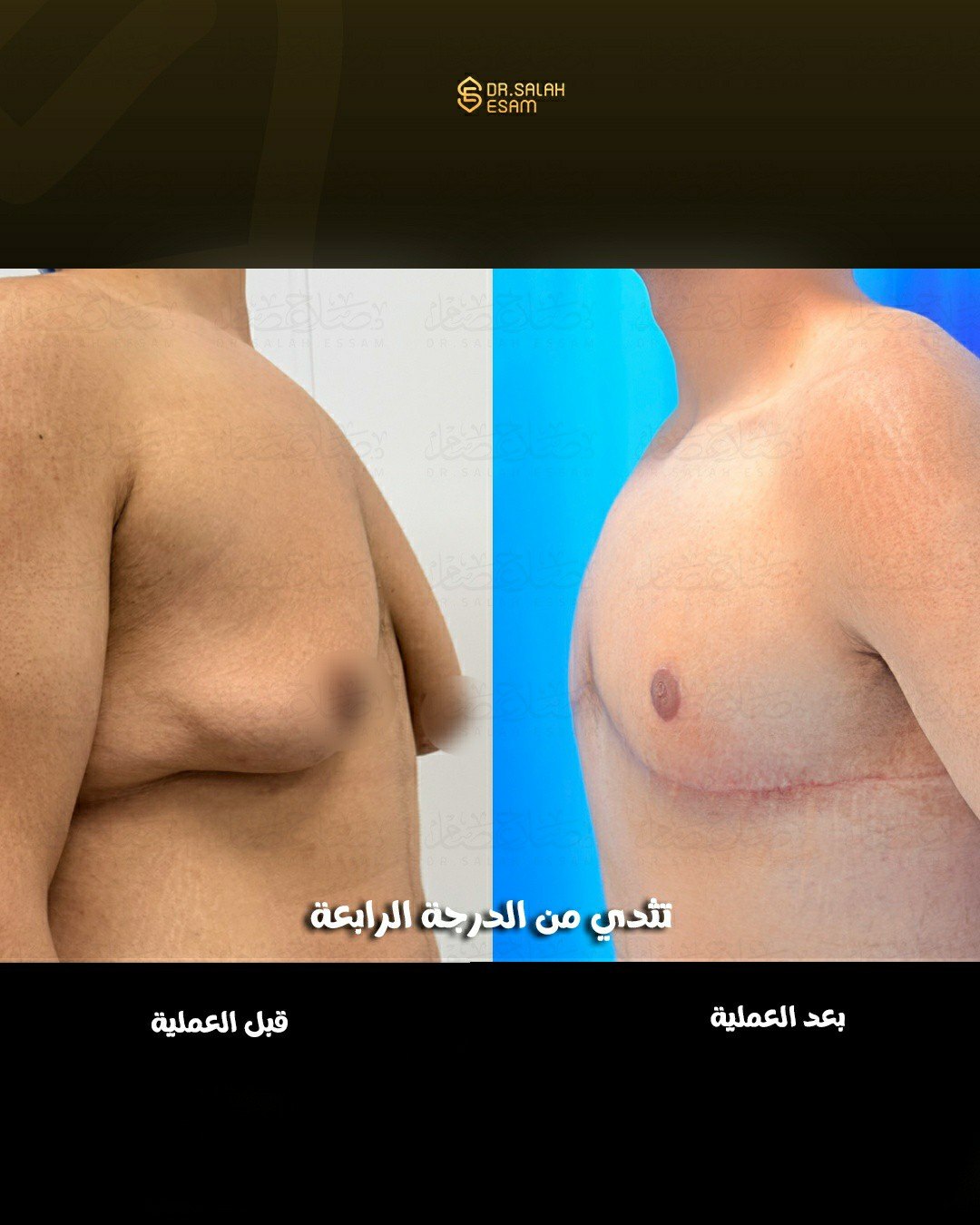 Body contouring result