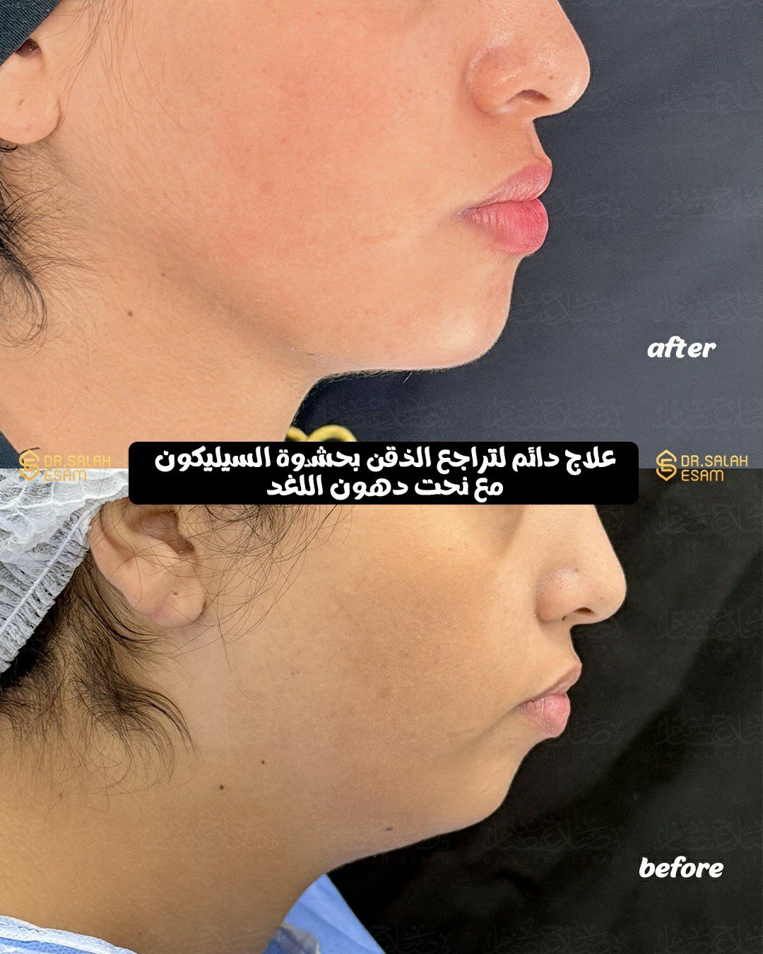 Chin augmentation and submental liposuction